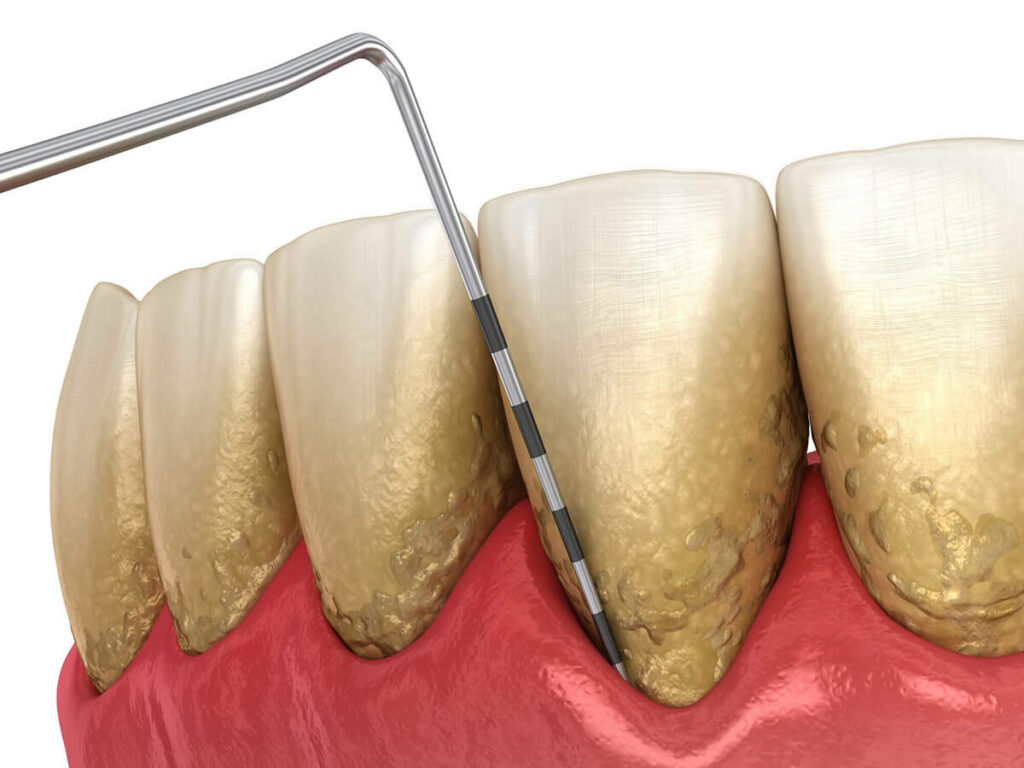illustration of a dental probe being inserted into the gums to identify gum disease