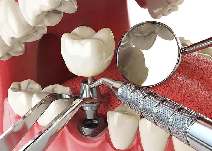 dental implant graphic