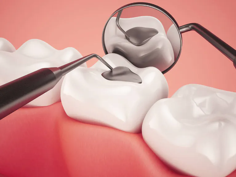 Dental fillings and dental sealants at Handcrafted Smiles in Arlington Heights, IL