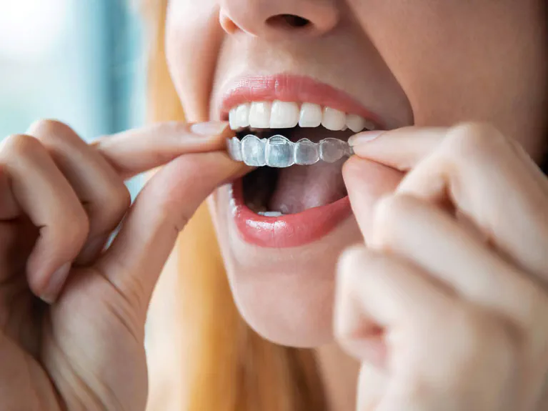 Invisalign clear aligners available at Handcrafted Smiles in Arlington Heights, IL