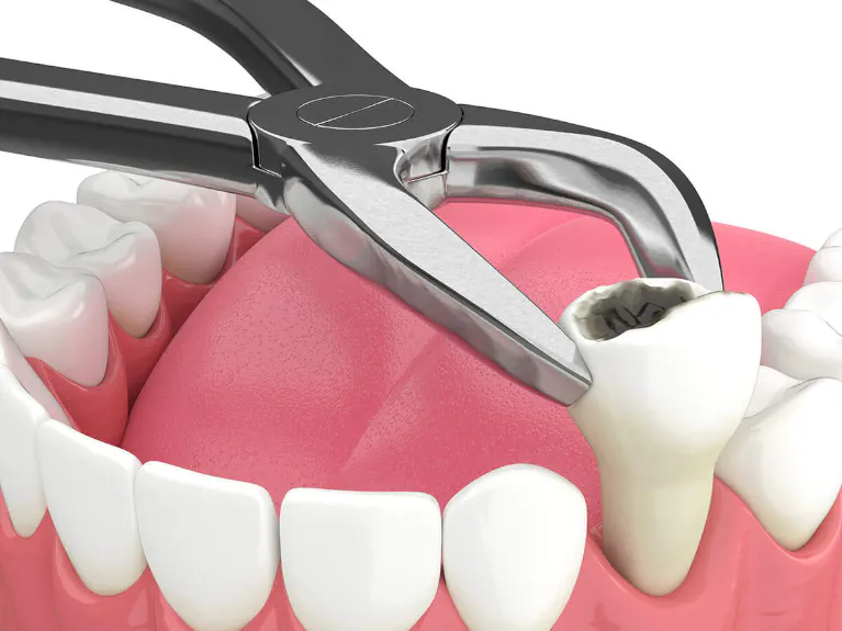 Tooth extractions available at Handcrafted Smiles in Arlington Heights, IL